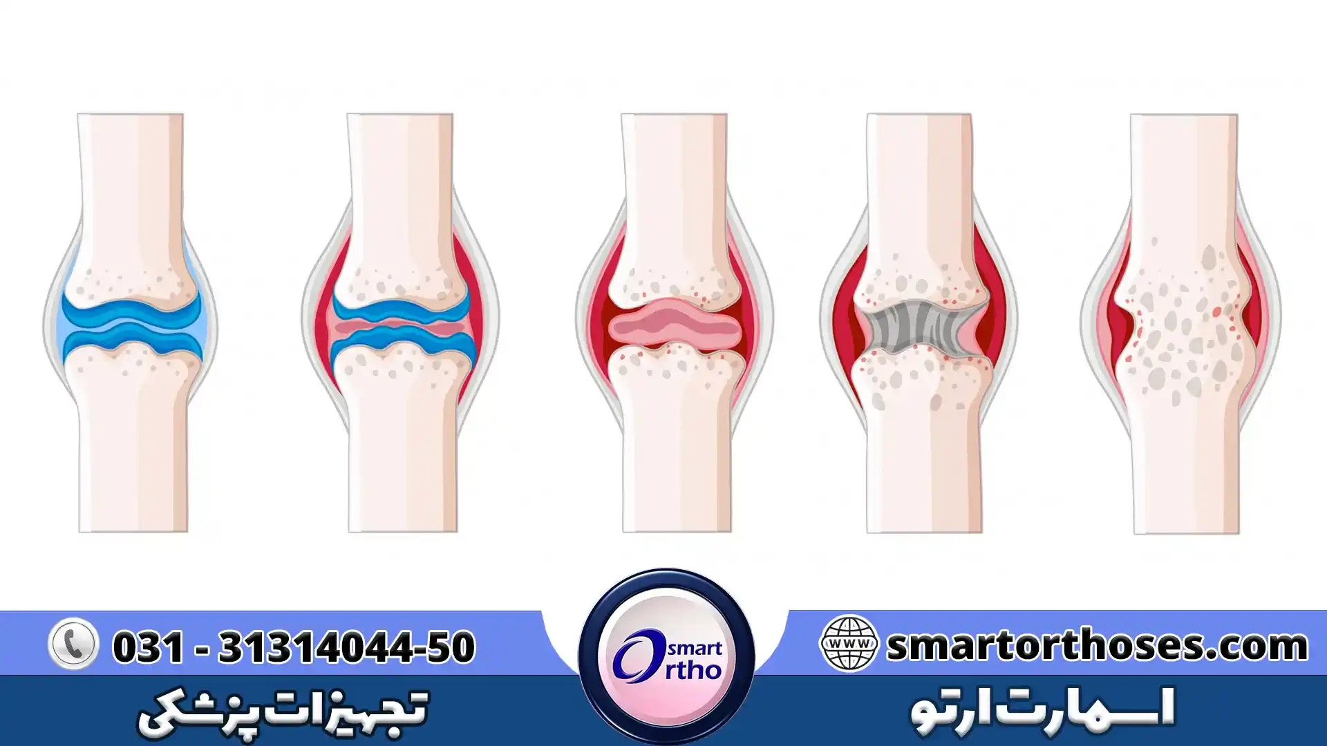 انواع آرتروز و علائم آنها