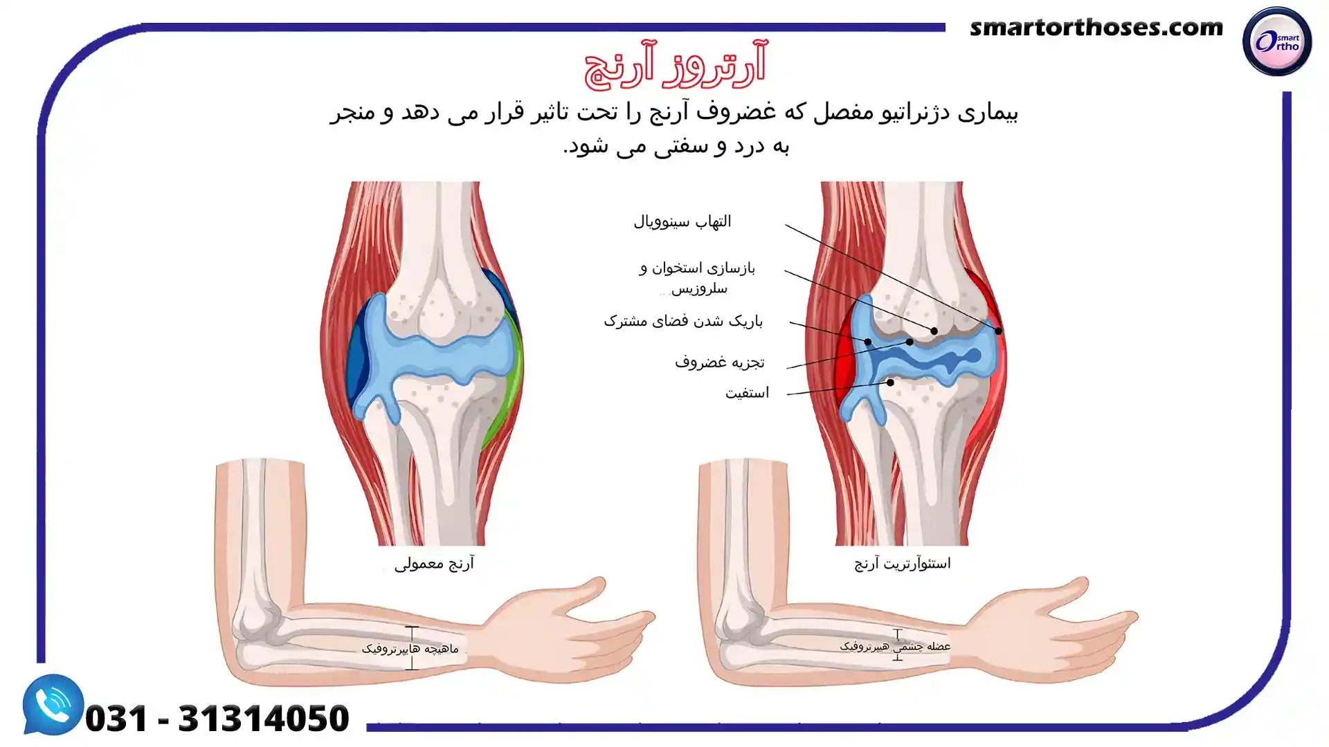 انواع آرتریت