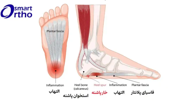 خار پاشنه پا