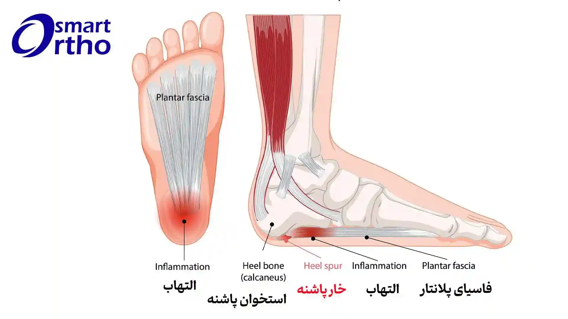 خار پاشنه  پا